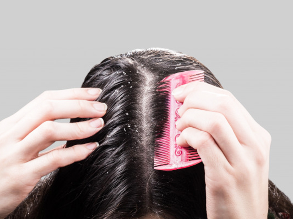 3 Easy Ways to Get Rid of Dandruff on the Scalp!